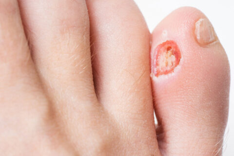 HERIDAS